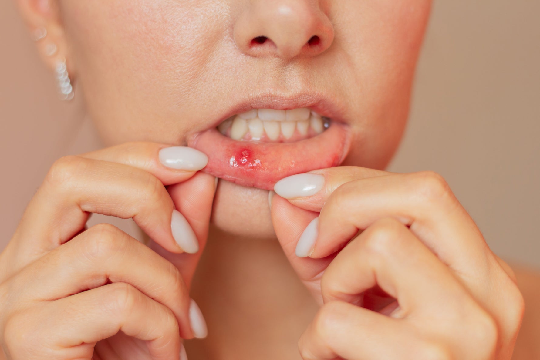 A close-up of a person pulling down their lower lip to reveal a mouth ulcers inside the mouth. 